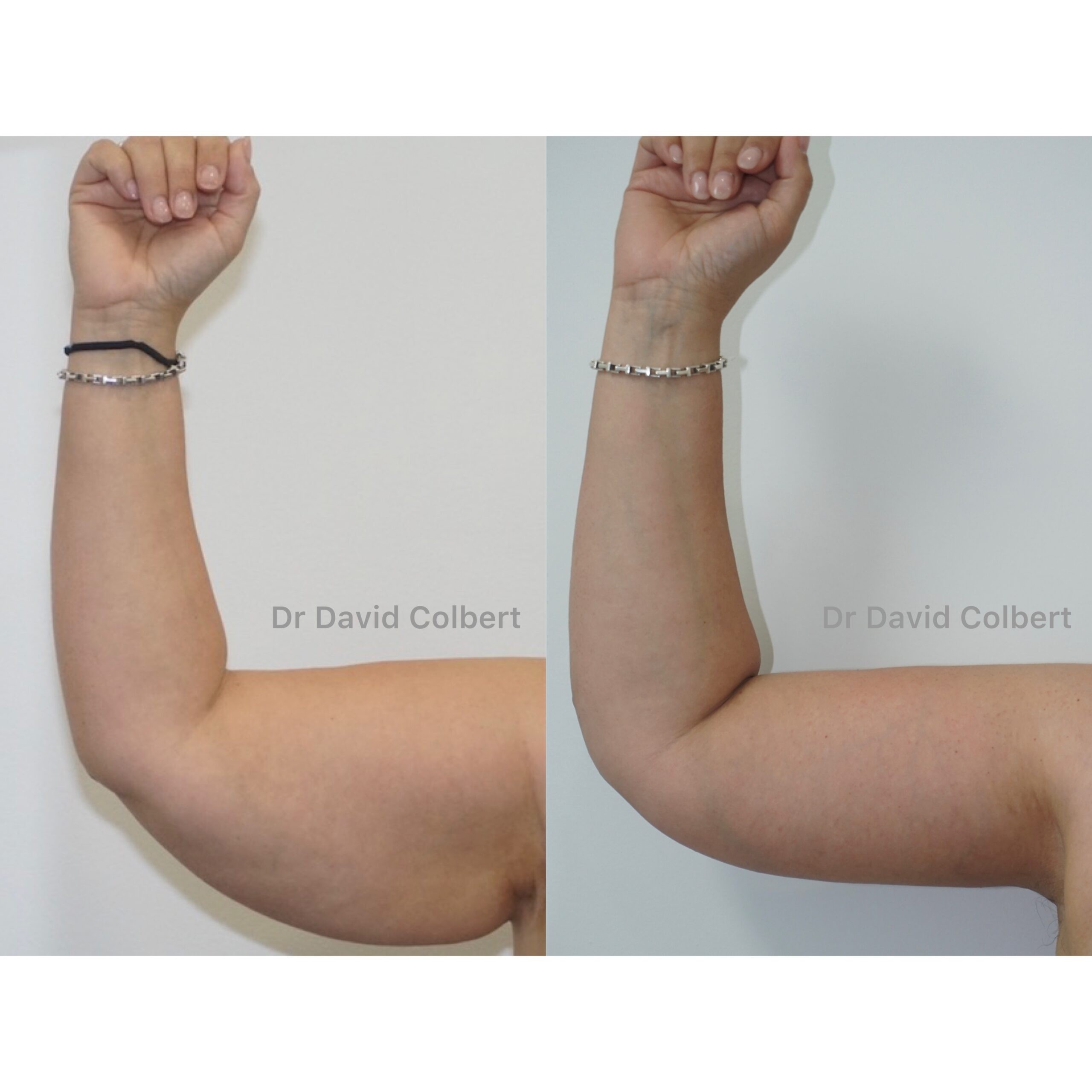 Arm lift David Colbert